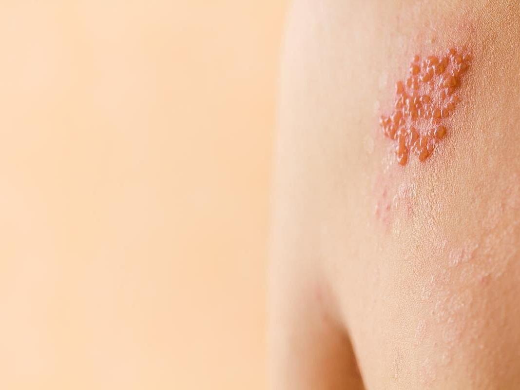 Shingles Vax Protects Against Heart Disease, Dementia, Death